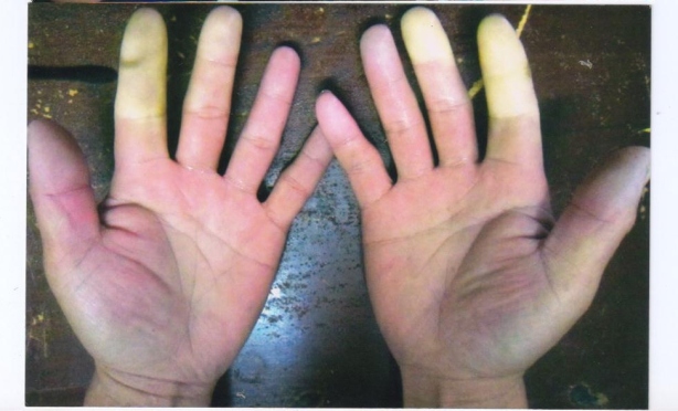 Victim's hands